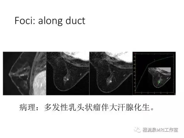 【PPT】乳腺非肿块样强化的鉴别诊断