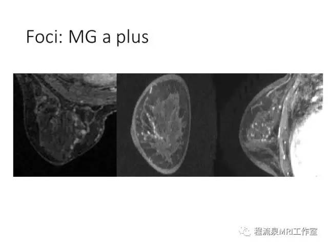 【PPT】乳腺非肿块样强化的鉴别诊断