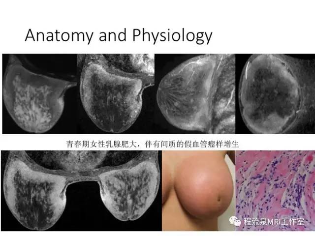 【PPT】乳腺非肿块样强化的鉴别诊断