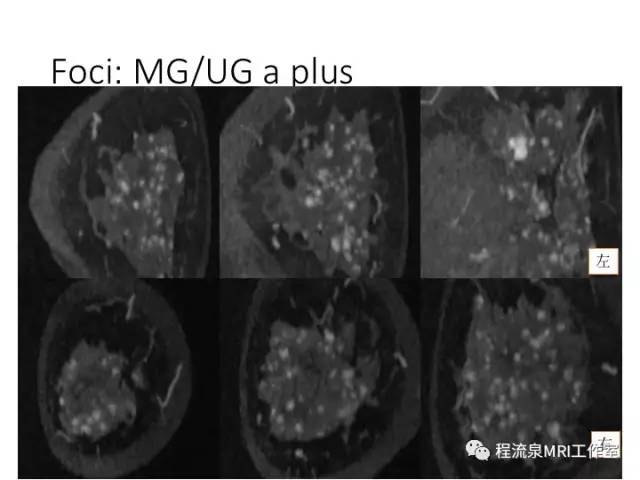 【PPT】乳腺非肿块样强化的鉴别诊断