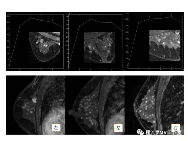 【PPT】乳腺非肿块样强化的鉴别诊断