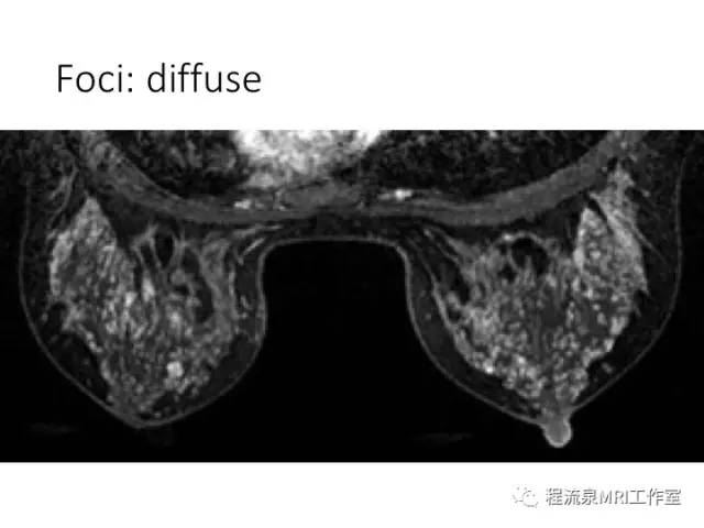 【PPT】乳腺非肿块样强化的鉴别诊断