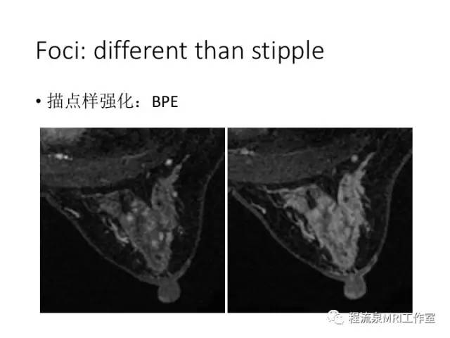 【PPT】乳腺非肿块样强化的鉴别诊断
