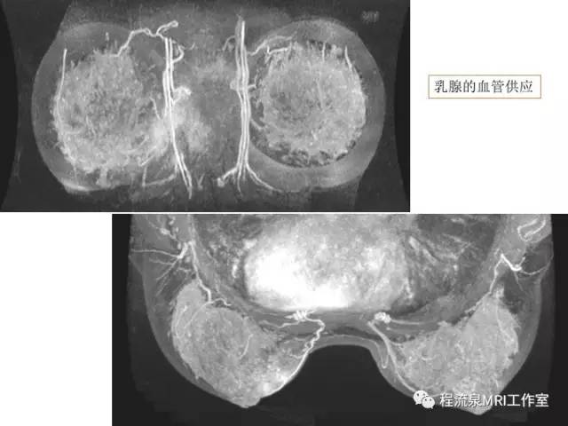 【PPT】乳腺非肿块样强化的鉴别诊断