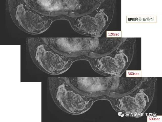【PPT】乳腺非肿块样强化的鉴别诊断
