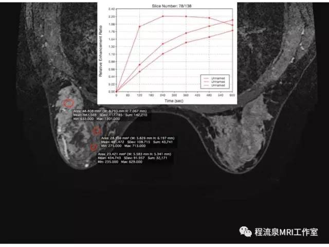 【PPT】乳腺非肿块样强化的鉴别诊断