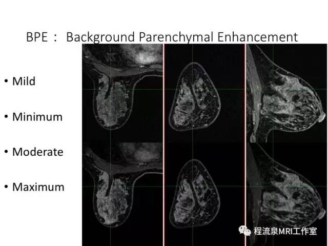 【PPT】乳腺非肿块样强化的鉴别诊断