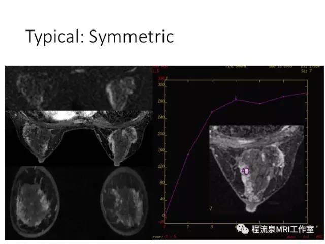 【PPT】乳腺非肿块样强化的鉴别诊断