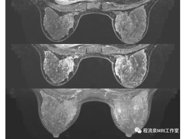 【PPT】乳腺非肿块样强化的鉴别诊断