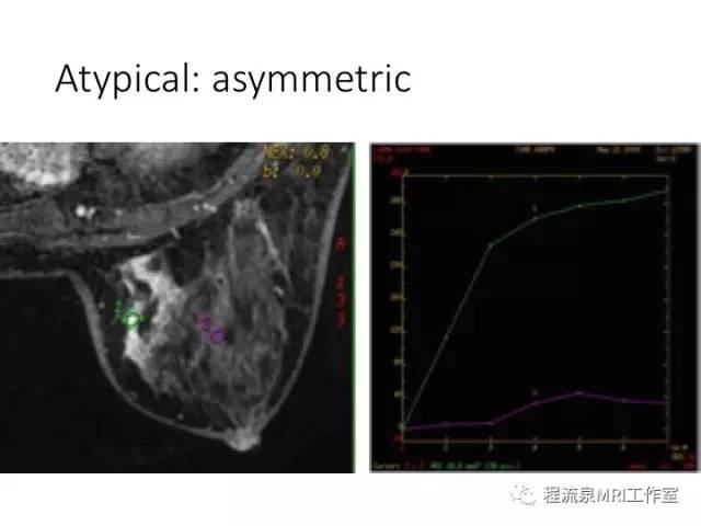 【PPT】乳腺非肿块样强化的鉴别诊断