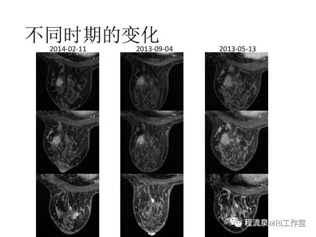 【PPT】乳腺非肿块样强化的鉴别诊断