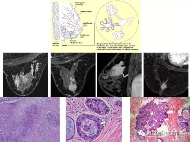 【PPT】乳腺非肿块样强化的鉴别诊断