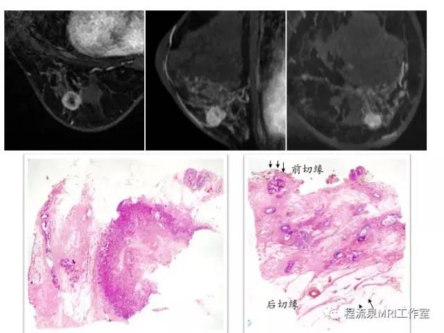 【PPT】乳腺非肿块样强化的鉴别诊断
