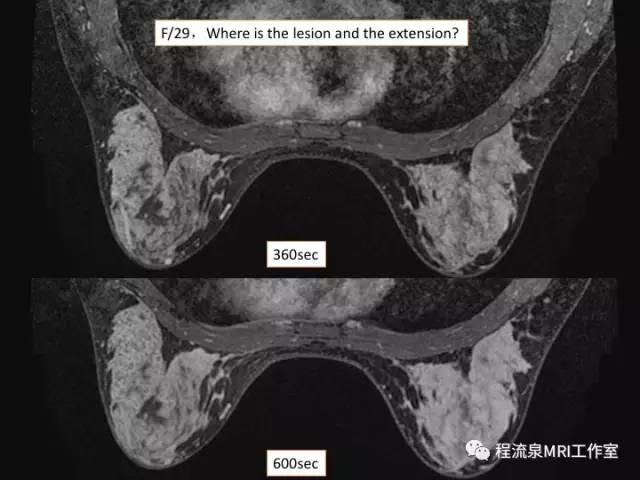 【PPT】乳腺非肿块样强化的鉴别诊断