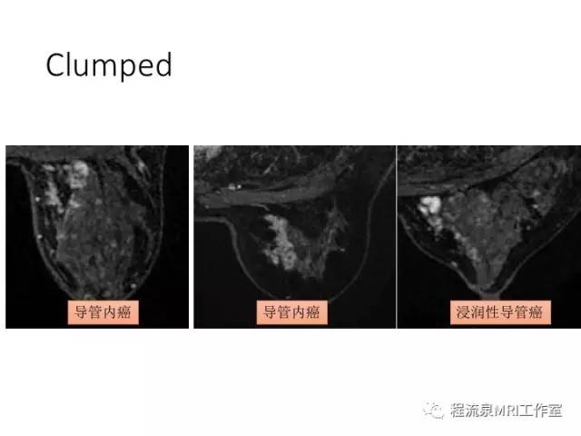 【PPT】乳腺非肿块样强化的鉴别诊断