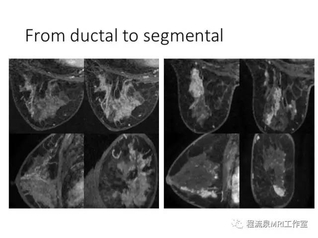 【PPT】乳腺非肿块样强化的鉴别诊断
