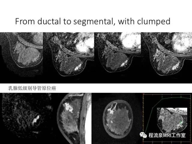 【PPT】乳腺非肿块样强化的鉴别诊断