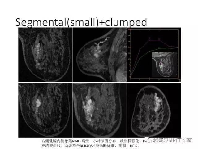 【PPT】乳腺非肿块样强化的鉴别诊断