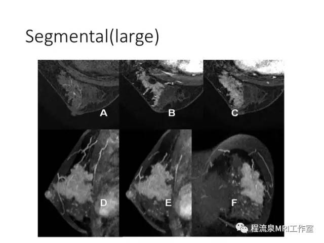 【PPT】乳腺非肿块样强化的鉴别诊断