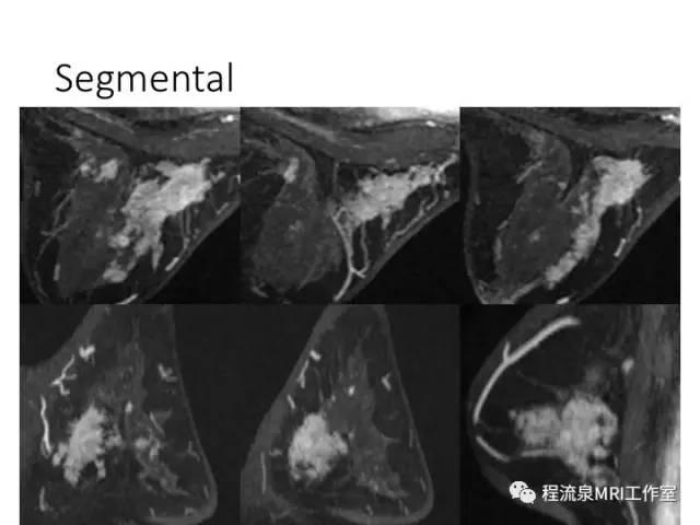 【PPT】乳腺非肿块样强化的鉴别诊断
