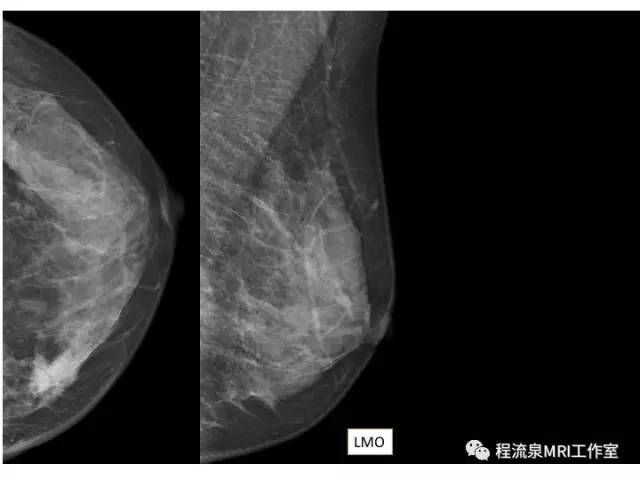 【PPT】乳腺非肿块样强化的鉴别诊断