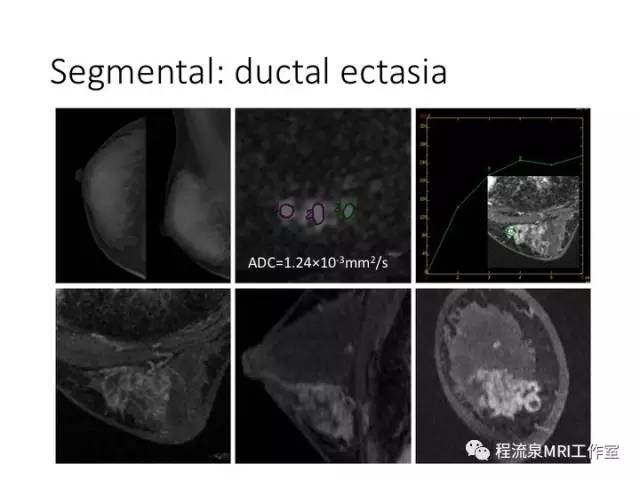 【PPT】乳腺非肿块样强化的鉴别诊断