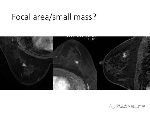 【PPT】乳腺非肿块样强化的鉴别诊断