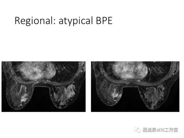 【PPT】乳腺非肿块样强化的鉴别诊断