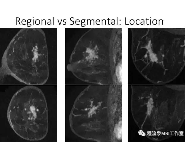 【PPT】乳腺非肿块样强化的鉴别诊断
