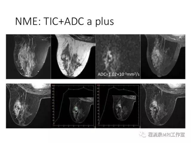 【PPT】乳腺非肿块样强化的鉴别诊断