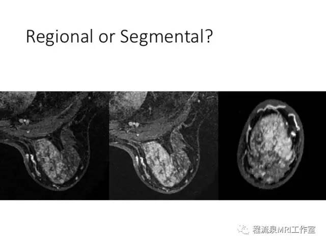 【PPT】乳腺非肿块样强化的鉴别诊断