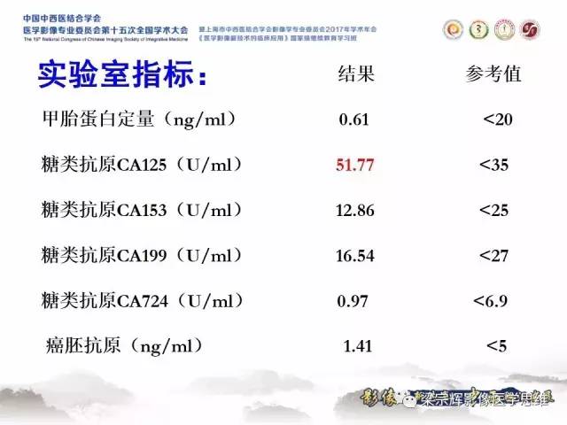 【病例】不典型肝脏海绵状血管瘤1例MR影像表现