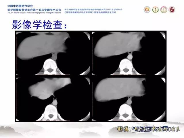 【病例】不典型肝脏海绵状血管瘤1例MR影像表现