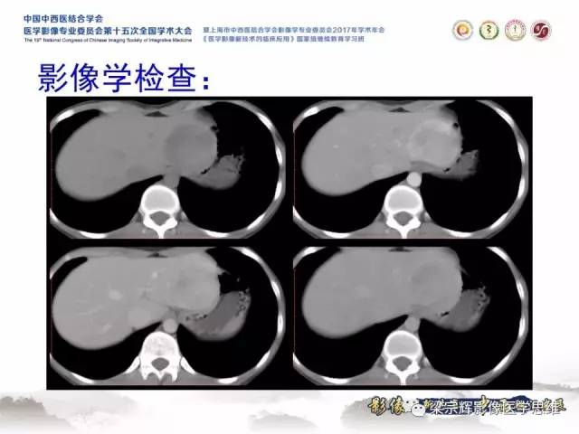 【病例】不典型肝脏海绵状血管瘤1例MR影像表现