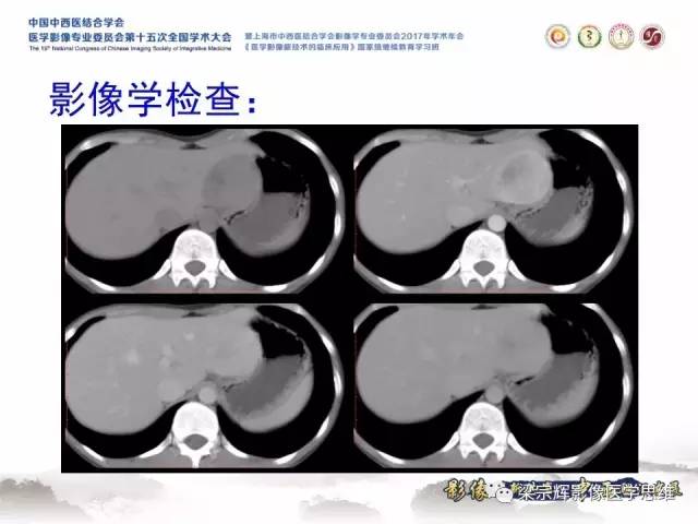 【病例】不典型肝脏海绵状血管瘤1例MR影像表现