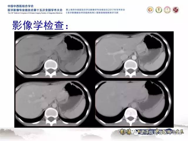 【病例】不典型肝脏海绵状血管瘤1例MR影像表现