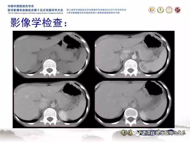 【病例】不典型肝脏海绵状血管瘤1例MR影像表现