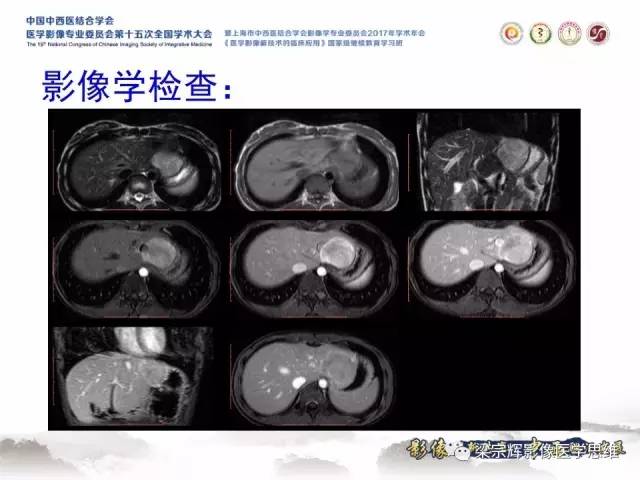 【病例】不典型肝脏海绵状血管瘤1例MR影像表现