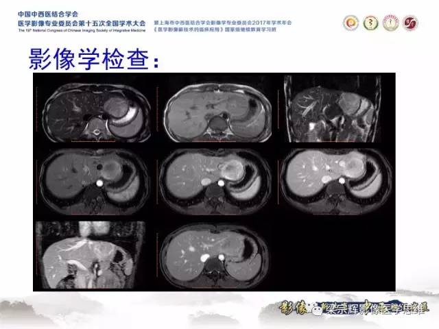 【病例】不典型肝脏海绵状血管瘤1例MR影像表现