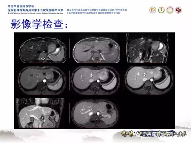 【病例】不典型肝脏海绵状血管瘤1例MR影像表现