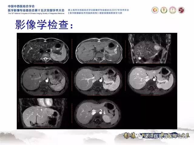 【病例】不典型肝脏海绵状血管瘤1例MR影像表现