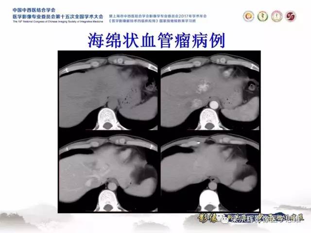 【病例】不典型肝脏海绵状血管瘤1例MR影像表现