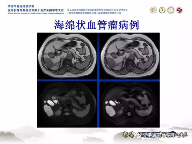 【病例】不典型肝脏海绵状血管瘤1例MR影像表现