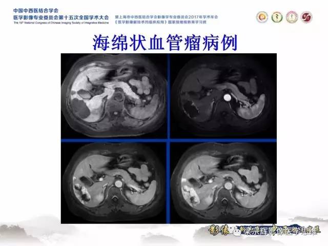 【病例】不典型肝脏海绵状血管瘤1例MR影像表现