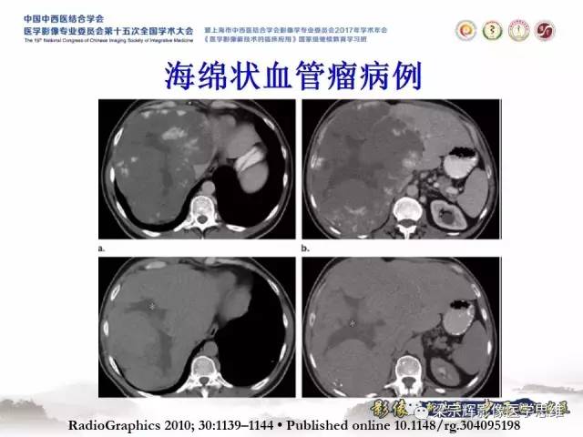 【病例】不典型肝脏海绵状血管瘤1例MR影像表现