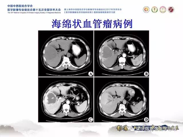 【病例】不典型肝脏海绵状血管瘤1例MR影像表现