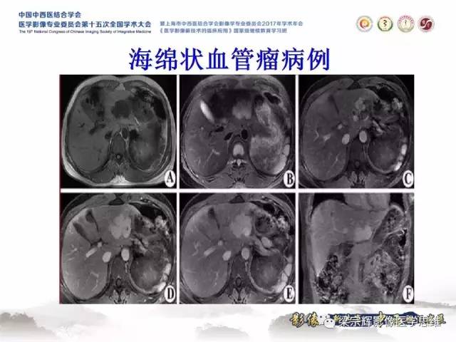 【病例】不典型肝脏海绵状血管瘤1例MR影像表现