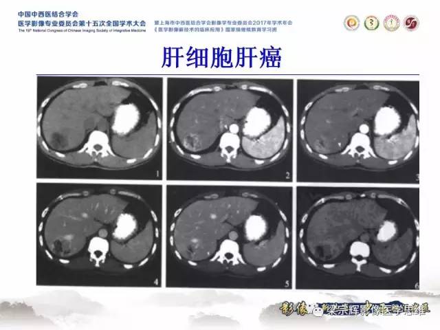 【病例】不典型肝脏海绵状血管瘤1例MR影像表现