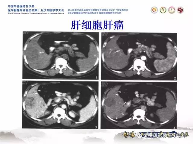【病例】不典型肝脏海绵状血管瘤1例MR影像表现