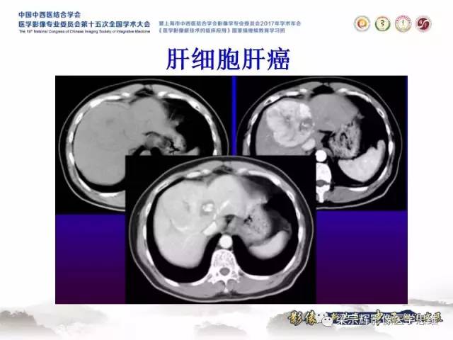 【病例】不典型肝脏海绵状血管瘤1例MR影像表现